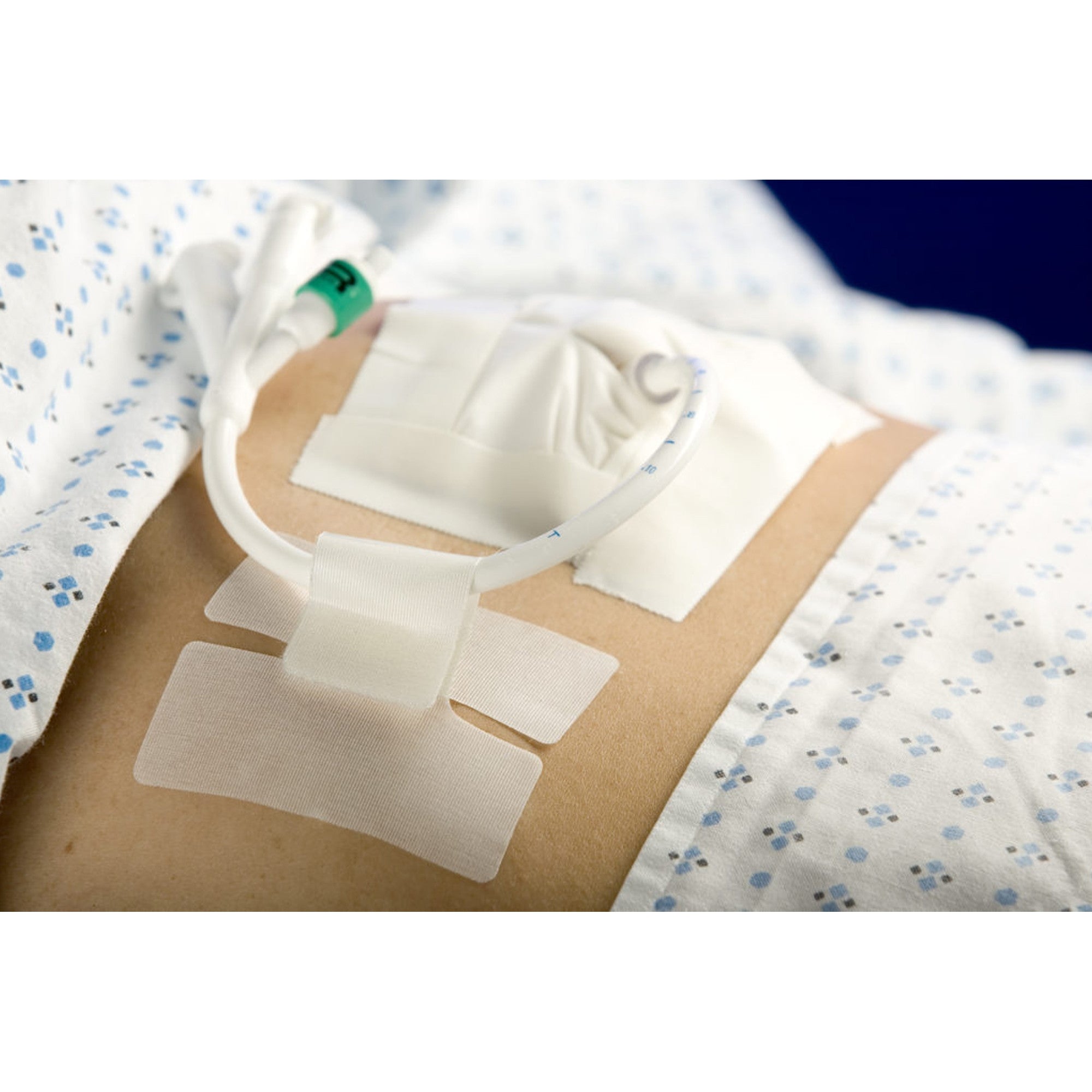 192067 - MC Johnson - Holder Tube Cath-Secure Single Hook and Loop Tab Hypoallergenic Tape Butterfly Design 5445-2 Box of 50, (BX)