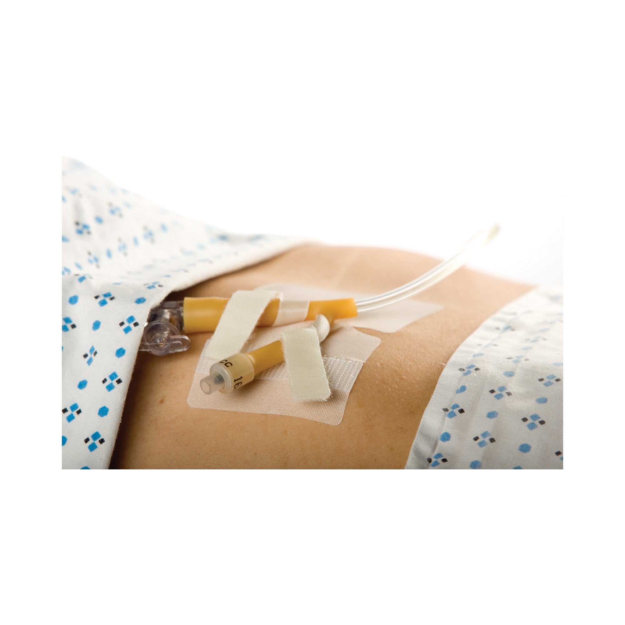 785700 - MC Johnson - Catheter Holder Cath-Secure Dual Tab 3 in, Wrap Tabs x 3 in, Wide Base 5445-4 Case of 400, (CS)