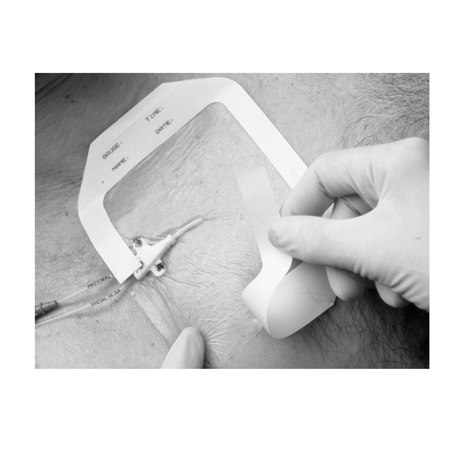 1630 - Solventum Corporation - Frame Style Transparent Dressing, 4" x 4½" with Label, 50/bx, 4 bx/cs (Continental US+HI Only)    , cs