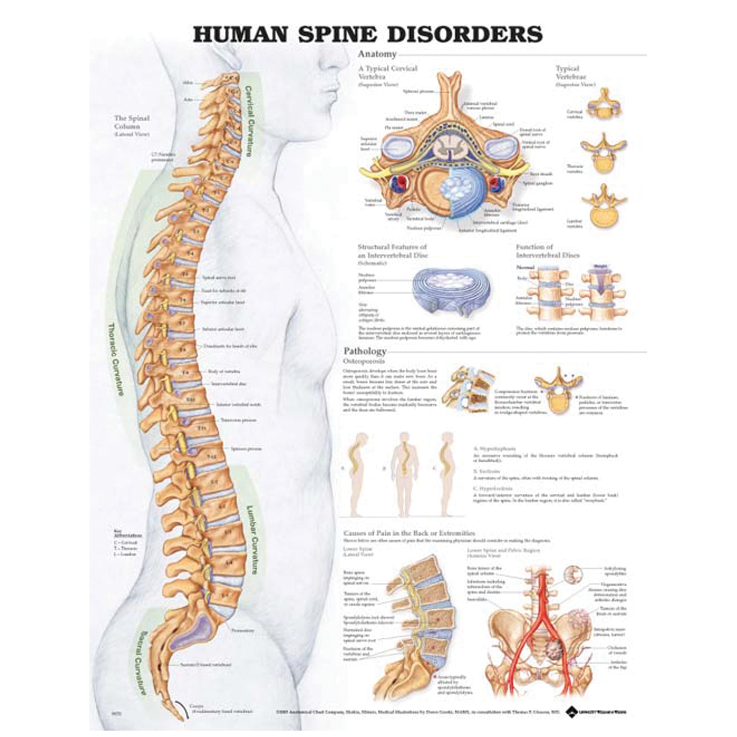 1587794659 - Anatomical Chart Company - Human Spine Disorders, 20" x 26", Styrene Plastic (026588) (DROP SHIP ONLY)    , ea
